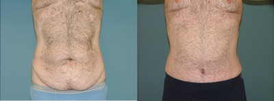 Tummy Tuck - 
	This male patient had a significant weight gain and loss. He had a significant amount of excess belly skin after this loss and desired an improvement in the contour. We decided on a tummy tuck and did do some additional muscle tightening as well.
