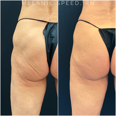 55-64 year old woman treated with Nonsurgical Butt Augmentation - Before and after Sculptra Butt Lift results