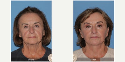 74 year old woman treated with Deep Plane Facelift, Neck Lift, Brow Lift, Lip Lift, MACS Facelift, Facelift - 74 year old woman treated with Deep Plane Face and Neck Lift, Endoscopic Brow Lift, Lip Lift, Full Anterior Face Laser, Fat Grafting, MAC