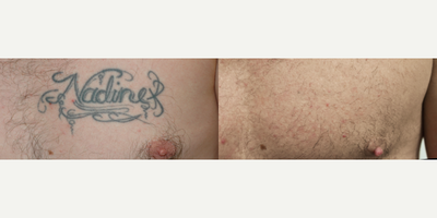 Las Angeles laser tattoo removal - Although tattoos are normally covered by our clothing, if you've got one that just doesn't feel like it fits, give us a call today about laser tattoo removal. #tattooremoval #lasertattooremoval #picosure
