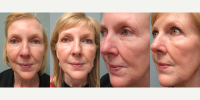 55-64 year old woman treated with BroadBand Light (BBL) - 55-64 year old woman treated with BroadBand Light (BBL)