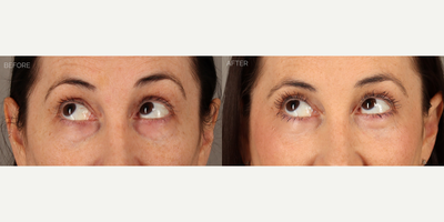 Upper and Lower Blepharoplasty with Fat Grafting and CO2 Laser - 38-year-old female with a history of displeasure with her upper eyelid contour and excess skin, and lower eyelid aging. She had tried and failed undereye fillers many times before deciding to undergo surgery. She is shown 6 months after an upper blepharoplasty (eyelid lift) with fat transposition to reduce upper eyelid skin redundancy and create a more youthful contour. She also underwent a transconjunctival (scarless) lower blepharoplasty to remove lower eyelid bags, fat grafting to the eyelids and mid-cheek to contour areas of hollowness, and fractionated CO2 laser to tighten and smooth skin.