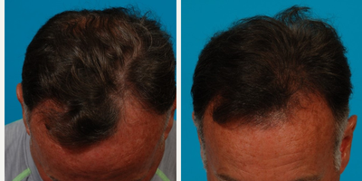 45-54 year old man treated with Hair Transplant - Middle aged man interested in hair transplantation. Tried over the counter products and was able to see results. After consulting with the doctor who recommended hair transplantation , patient received 1500 hair graft using the newest technology follicular unit extraction versus the old method which leaves you with a linear scar on the back of your scalp. Pt achieved this result 7 months post treatment.