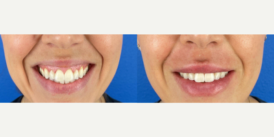 25-34 year old woman treated with Lip Fillers - Patient before and one month post procedure showing more volume in top and bottom lip