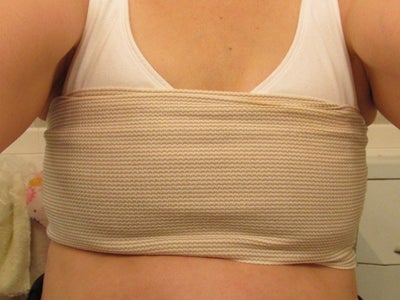Breast implant removal (explant) Case 1 Before After Photos Orange