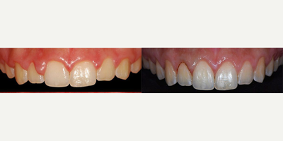 18-24 year old man treated with Gum Lift - The new trend in cosmetic dentistry are long white teeth, in this case, our patient could get better aesthetics on his teeth and gums healthier not to collect food residue.