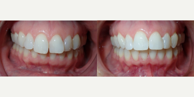 45-54 year old woman treated with InBrace - 16 months treatment time