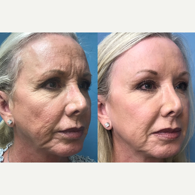 55-64 year old woman treated with Brow Lift, Eyelid Surgery, Chemical Peel - Patient had a Brow Lift, Upper eyelid lift and a chemical peel (Croton Oil Peel)