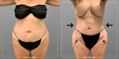 45-54 year old woman treated with AirSculpt - Ever feel a bit pear-shaped? Unwanted fat tends to rest in certain areas depending on your body type, which can quickly prompt a lack of self-confidence. Thankfully, even the body parts most resistant to exercise, such as the pubic region, can have fat removed gently and permanently with our patented technology. This patient started with Pubic AirSculpt, then added Stomach and Back Bra Roll fat removal to transform her previous pear shape into an hourglass figure.