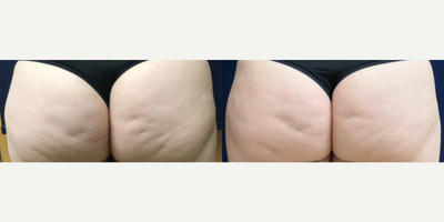 Woman treated with Qwo - QWO (Cellulite Treatment) for the Buttock area.This young patient was bothered by some of the dimpling/cellulite. We treated her with a total of three treatments. There is much improvement, especially if you notice on the right buttock! Her dimples are about 70% better after the 3 treatments. Wed like to try one more treatment and see those dimples disappear even more.This treatment is done in 3 series, 3 weeks apartFDA- Approved injectable to treat cellulite Bruising occurs post treatment- but does resolveEasily tolerated procedure with no downtime