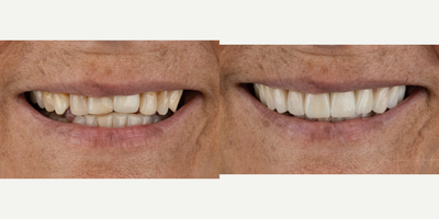 55-64 year old woman treated with Dental Bridge - This smile was reconditioned with veneers, crowns, an implant and bridge to create a harmonious smile.