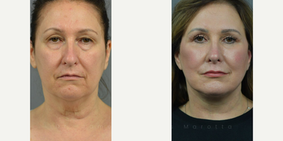 Woman treated with Septoplasty - BlepharoplastyDeep Plane FaceliftFat GraftingLaser or Renuvion Skin ResurfacingSeptorhinoplasty