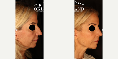 Woman treated with Rhinoplasty - It's amazing how one procedure can have such a massive impact on the balance of the rest of the face.I performed a rhinoplasty -- no other procedures (!!) -- on this beautiful patient. In these photos, she is only 3 weeks out, and still swollen along the bridge and tip. And yet every part of her face looks more refreshed; more rejuvenated.Facial analysis is a critical part of my consultation. Identifying the areas that create disharmony and unlocking the natural beauty of your face.