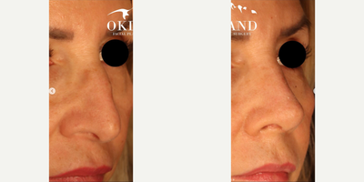 Woman treated with Rhinoplasty - It's amazing how one procedure can have such a massive impact on the balance of the rest of the face.I performed a rhinoplasty -- no other procedures (!!) -- on this beautiful patient. In these photos, she is only 3 weeks out, and still swollen along the bridge and tip. And yet every part of her face looks more refreshed; more rejuvenated.Facial analysis is a critical part of my consultation. Identifying the areas that create disharmony and unlocking the natural beauty of your face.