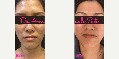 Woman treated with Moxi - She is shown before and after only one treatment. Her results will only improve with subsequent treatments.