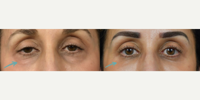Eyelid Surgery - Woman treated with Eyelid Surgery