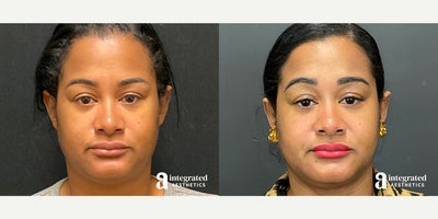 35-44 year old woman treated with AccuTite - The patient is a 36 year-old female who had aesthetic concerns with her submental/jowl region of the face. Dr. Cho performed Accutite to the lower face/neck and MyEllevate. The after results are 2 months post procedure.