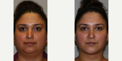 Woman treated with Chin Surgery - Woman treated with Chin Surgery using implant to enhance jawline, shown 5 days post op. She also had Chin Liposuction to contour neck/chin area as well as FaceTite and Buccal Fat Removal to thin the cheeks and face, and facial fat transfer to shape and contour the face.