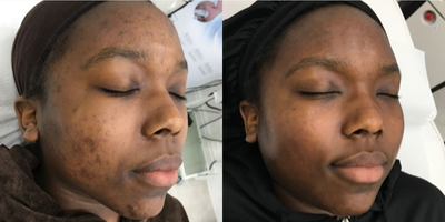 18-24 year old woman treated with Obagi Nu-Derm - Before and After Obagi Blue Peel x3. Paired with at home Obagi skin care.