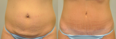 36 year old woman treated with Tummy Tuck - 36 year old female 2 years following a Drainless Tummy Tuck using a progressive tension closure technique.