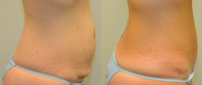 36year old woman treated with Tummy Tuck - 36 year old female 2 years following a Drainless Tummy Tuck using a progressive tension closure technique.