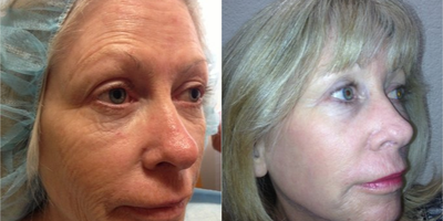 45-54 year old woman treated with MiXto Laser - Treated with MiXto laser & Ultherapy