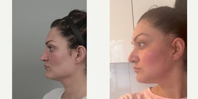 25-34 year old woman treated with AccuLift, Facial Fat Transfer, Forehead Reduction, Mini Facelift, Revision Rhinoplasty, Rhinop - .