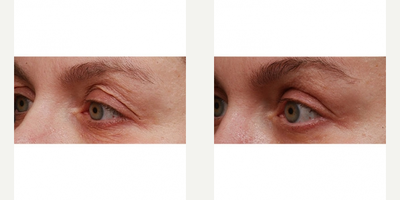 Woman treated with SkinMedica - 45 year old female,before and after 5 weeks of HA5 Rejuvenating Complex around the eye.
