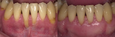 53 year old male treated for mucogingival defect - Patient just completed orthodontics. Patients was unable to maintain good oral hygiene per lack of mucogingival coverage. A gingival graft was placed for thickness and a connective tissue graft was placed for coverage. The technique used is called a tunnel.