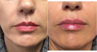 45-54 year old woman treated with Volbella - 51 year old female 1 syringe of Juvederm Ultra XC and 1 syringe of Juvederm Volbella to add volume and smooth out fine lines in the pink and white lip, Nasolabial folds, marionettes and chinAfter photos taken 2 weeks post injection.