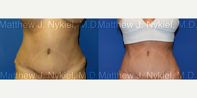 Woman treated with Tummy Tuck Revision - Woman treated with Tummy Tuck Revision