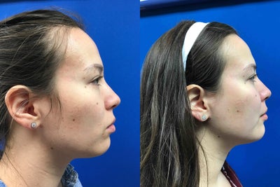 25-34 year old woman treated with Restylane Lyft - Restylane Lyft injection to define cheek bone, jawline, and neck.Dr. Caughlin is getting known for his chin, neck and jawline sculpting.