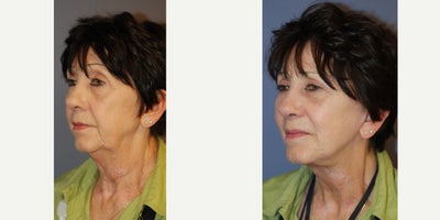 55-64 year old woman treated with Neck Lift - 65 year old woman undergoing necklift