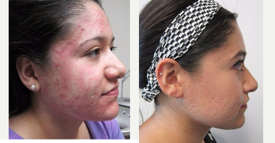18-24 year old woman treated with Smoothbeam Laser - Patient had 6 treatments of the Smoothbeam Laser spread a month apart.