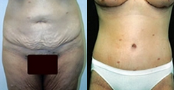 Panniculectomy - Panniculectomy