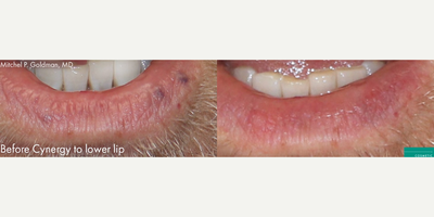 Man treated with YAG Laser - Cynergy to treat lesions on lower lip
