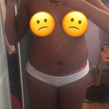 Elite Aftercare Bbl Lipo Dr Ali Uckan Izmir Tr Review