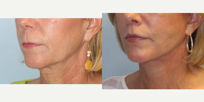 55-64 year old woman treated with Facelift - Facelift performed by Dr. Bryson Richards. She also had a lip lift.