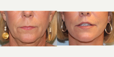 55-64 year old woman treated with Lip Lift - Lip lift performed by Dr. Bryson Richards. She also had a facelift.