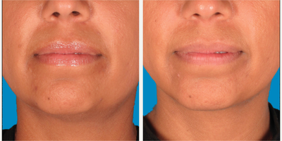 35-44 year old woman treated with Kybella for corruption of sub mental fullness /double chin - 35-44 year old woman treated with Kybella for corruption of sub mental fullness /double chin