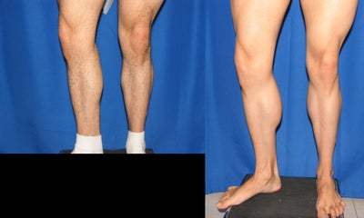 Calf Augumentation - 
	Patient's calf muscle did could not get any larger by exercise alone, so implants were necessary to achieve the perfect and proportional calf size.
