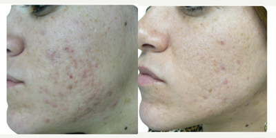 17 or under year old man treated with LaserACNE TREATMENT - LASER ACNE TREATMENT