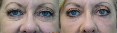 55-64 year old woman treated with Fractionated CO2 Laser - This patient requested rejuvenation of her eyes, specifically for the wrinkles and excess skin above the lids. Under local anesthesia in our Center, we performed a lower eyelid and crow's feet fractional CO2 laser treatment, along with a conservative upper eyelid lift (as per her request). Her results demonstrate a refreshed and natural appearance with decreased wrinkles under her eyes and less hooding above.