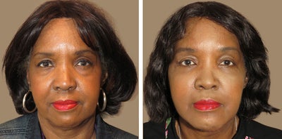 Face lift ,midface lift, blepharoplasty and chin augmentation - Complex facial rejuvenation before and after facelit, blepharoplasty, midface lift, necklift, chin augmentation with silicone implant