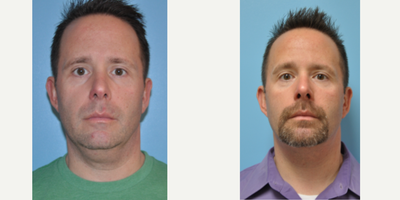 45-54 year old man treated with ThermiTight - 51 year old male underwent ThermiTight surgery under local anesthesia.