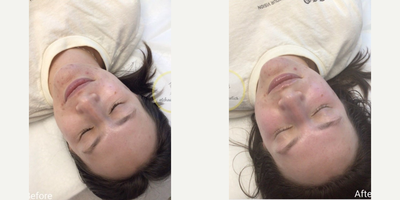 Woman treated with Dermaplaning - Woman treated with Dermaplaning