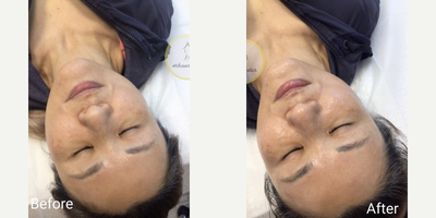 Woman treated with Dermaplaning - Woman treated with Dermaplaning