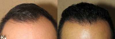 Man treated with Hair Transplant, ARTAS Robotic Hair Transplant - Man treated with Hair Transplant, ARTAS Robotic Hair Transplant