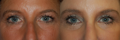 Brow Lift - 
	Brow Lift, Female
