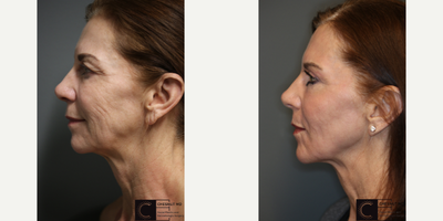 Silhouette Soft - Laser treatment with a lift.